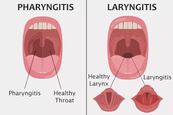 Faringitis dan Laringitis