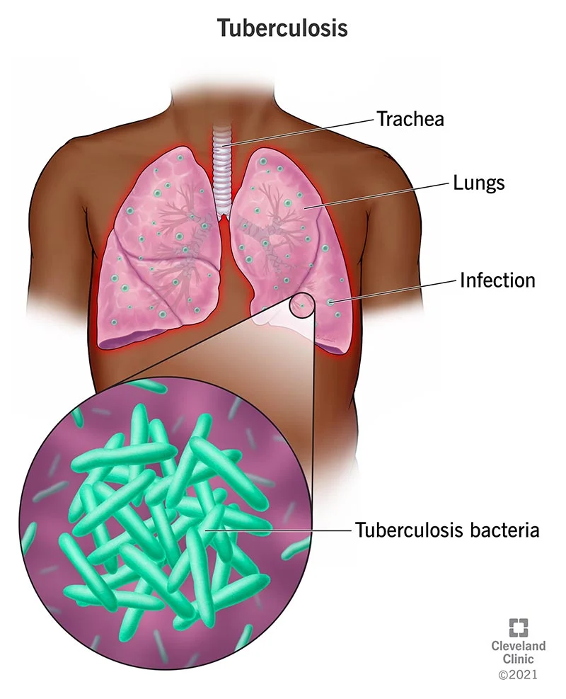 Infeksi Bakteri Tuberkulosis