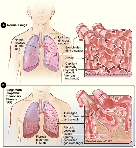 Paru-Paru Normal dan Fibrosis Paru