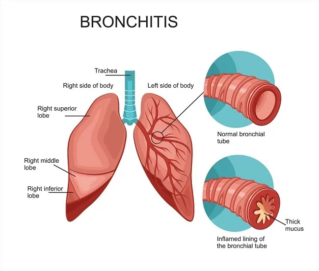 Penyakit Bronkitis